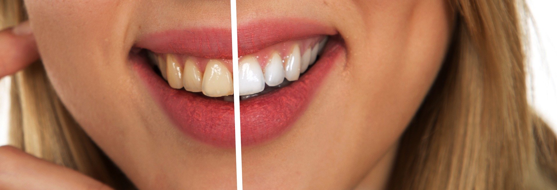 wybielanie zębów UNIDENT KRAKÓW Gabinet Stomatologiczny dentysta Kurdwanów
